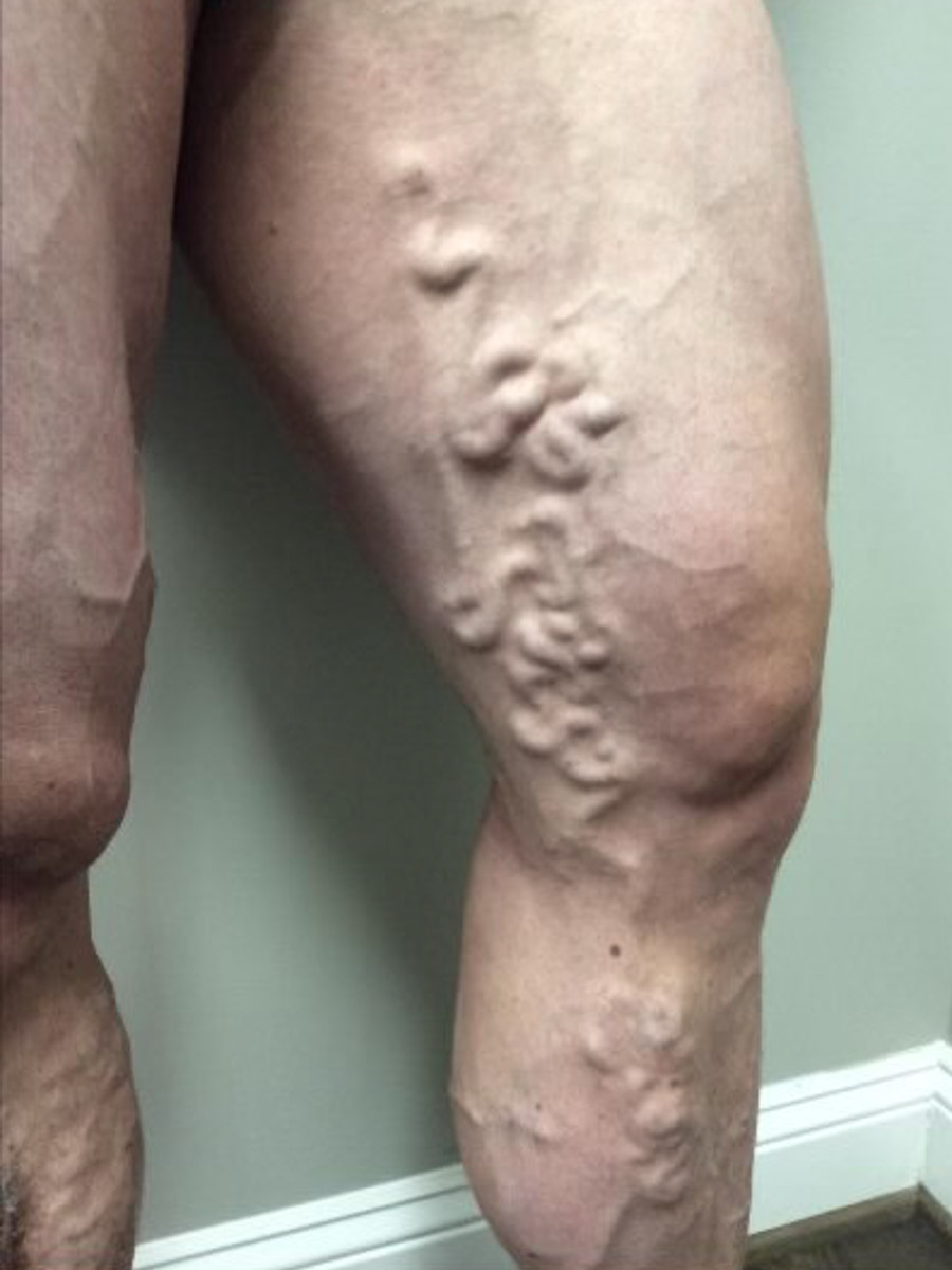 Carolina Vein Care & Aesthetics | Greenville, SC | Before After Results: Vein Care, Varicose Veins