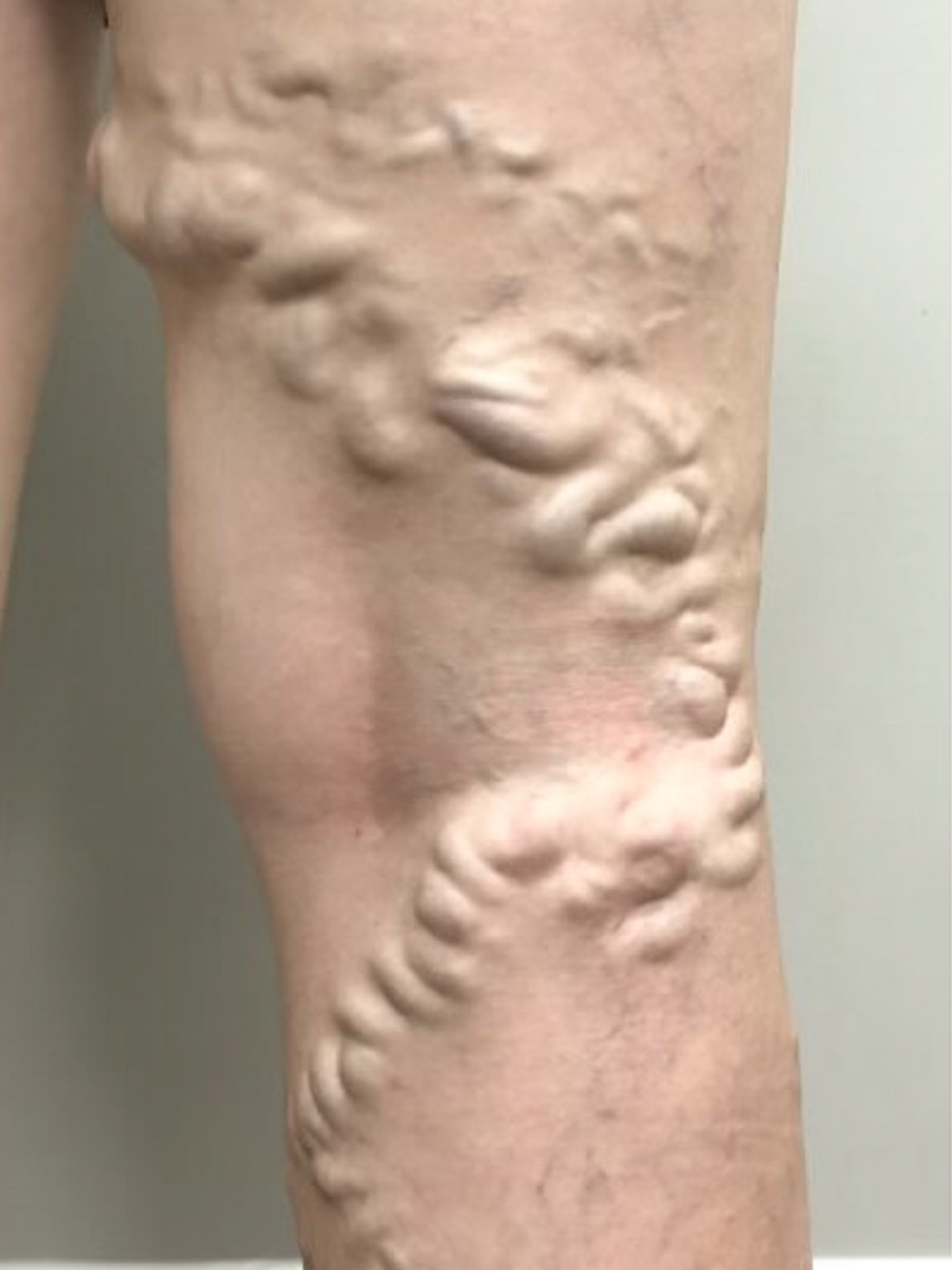 Carolina Vein Care & Aesthetics | Greenville, SC | Before After Results: Vein Care, Varicose Veins