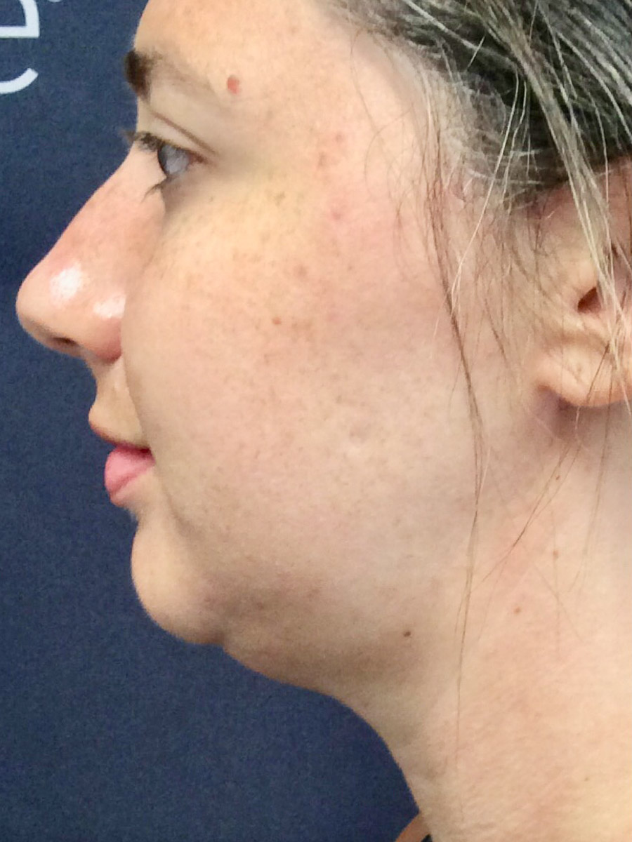 Carolina Vein Care & Aesthetics | Greenville, SC | Before After Results: Aesthetics, Tumescent Liposuction