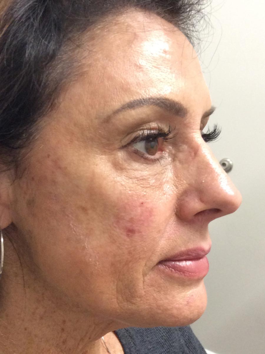 Carolina Vein Care & Aesthetics | Greenville, SC | Before After Results: Aesthetics, Restylane