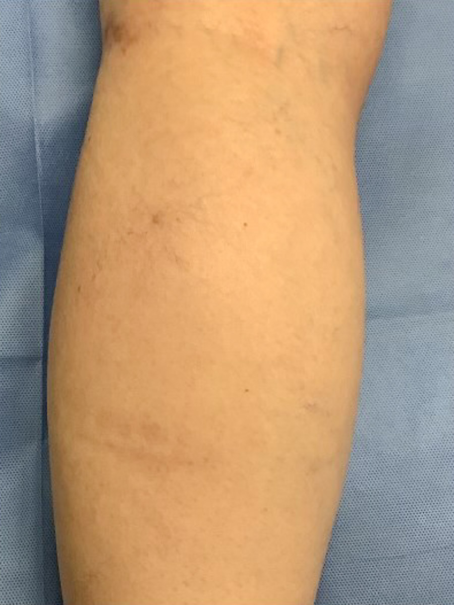 Carolina Vein Care & Aesthetics | Greenville, SC | Before After Results: Vein Care, Spider Veins