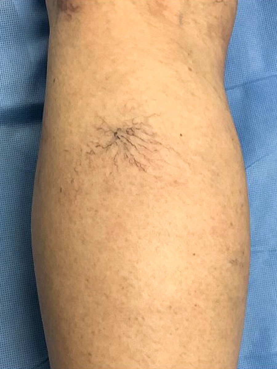 Carolina Vein Care & Aesthetics | Greenville, SC | Before After Results: Vein Care, Spider Veins