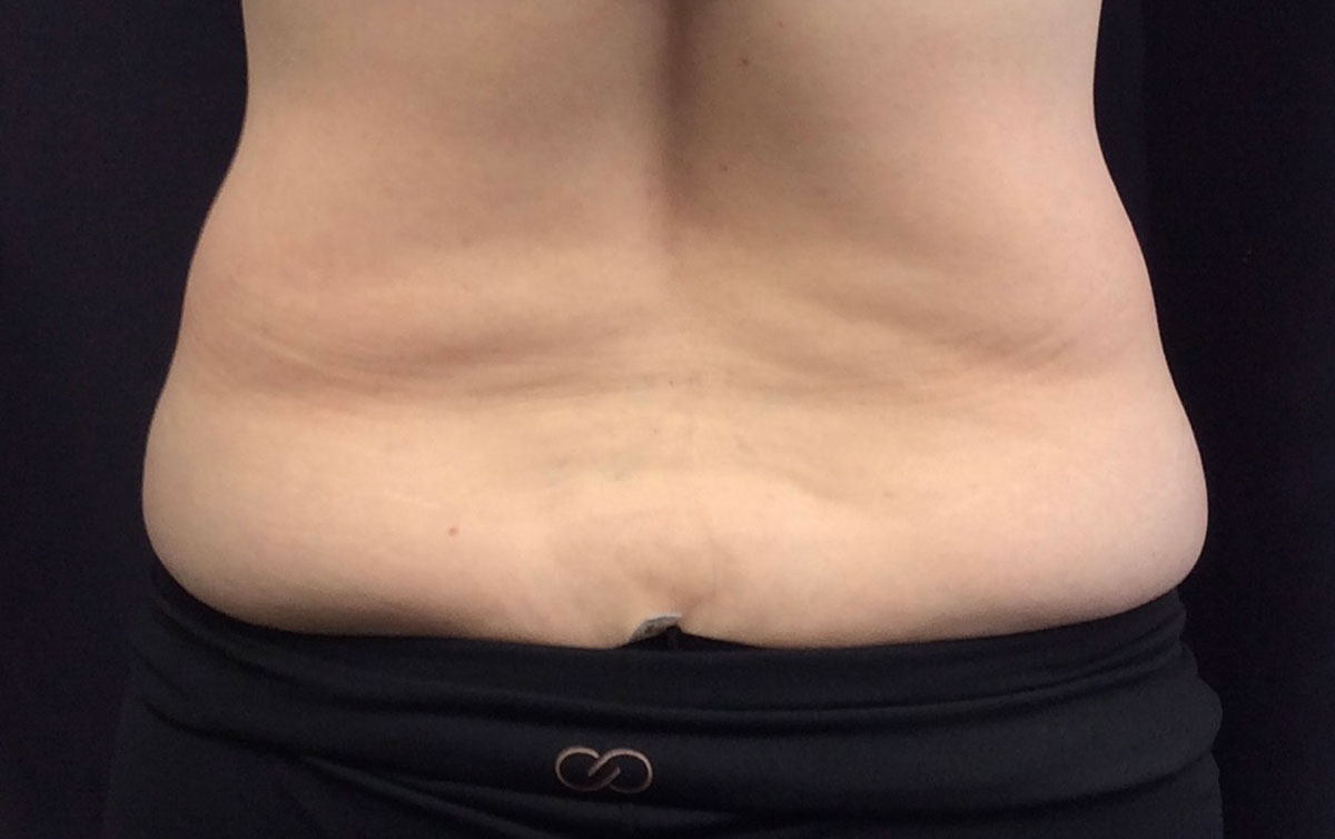 Carolina Vein Care & Aesthetics | Greenville, SC | Before After Results: Aesthetics, SculpSure