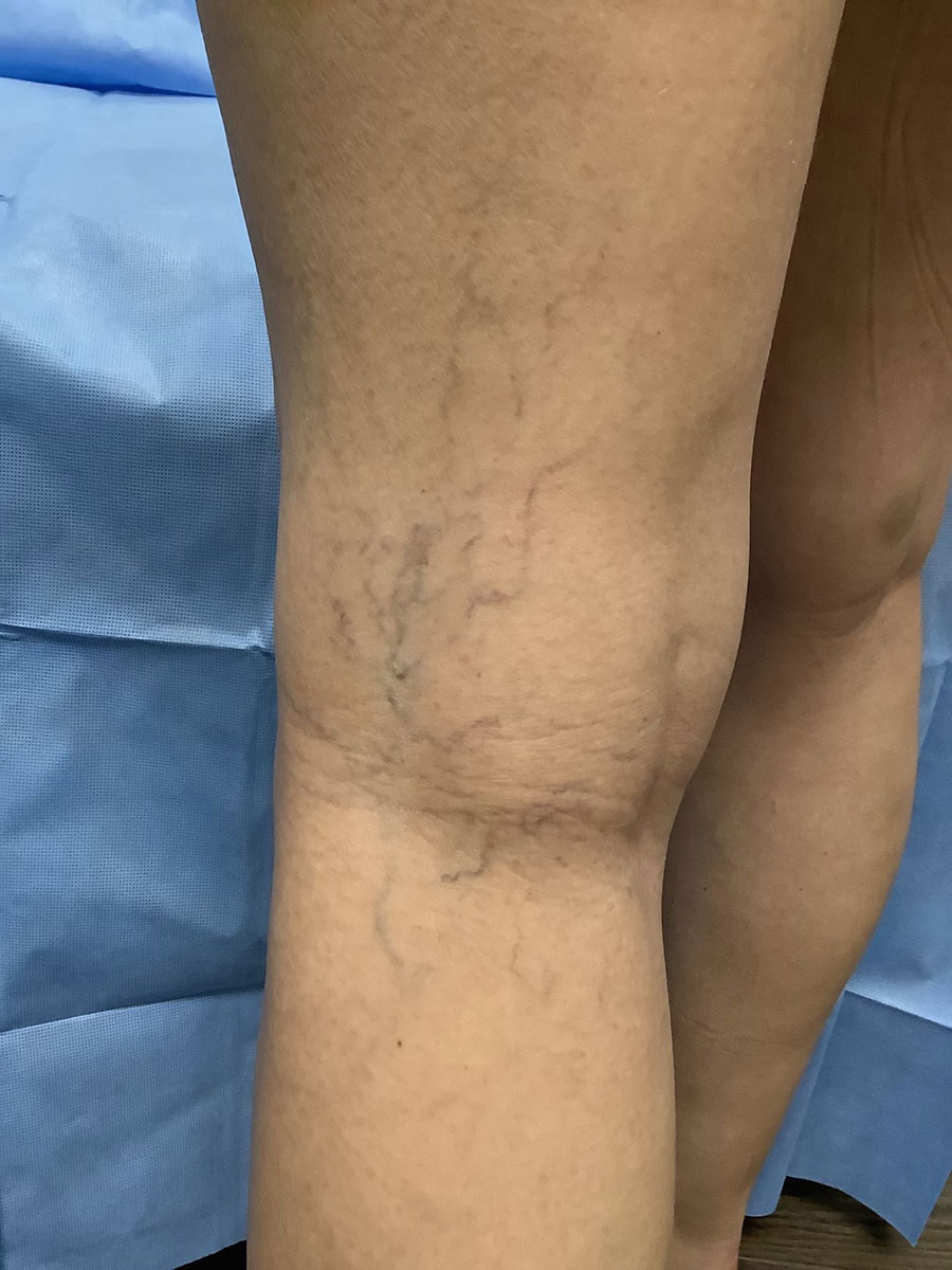 Carolina Vein Care & Aesthetics | Greenville, SC | Before After Results: Spider Veins