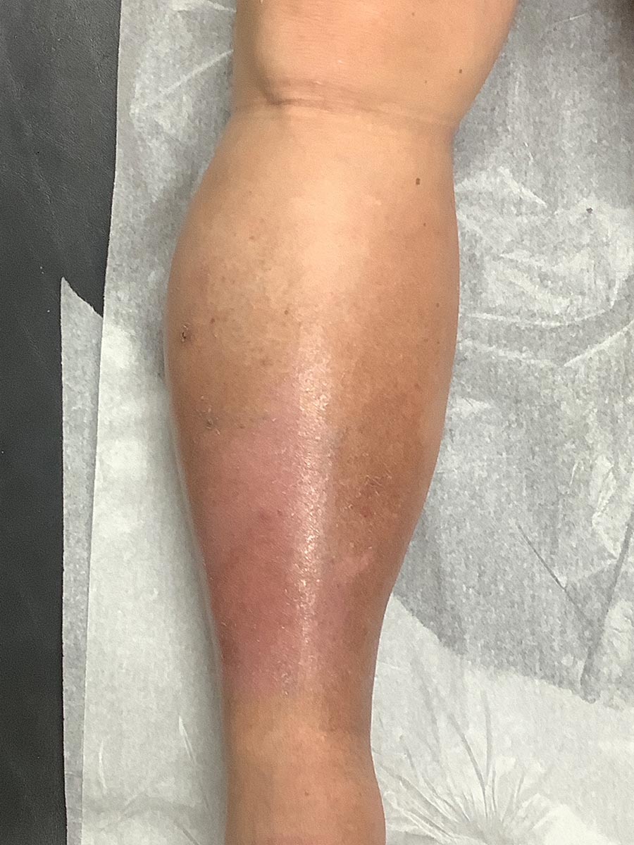 Carolina Vein Care & Aesthetics | Greenville, SC | Before After Results: Leg Ulcers