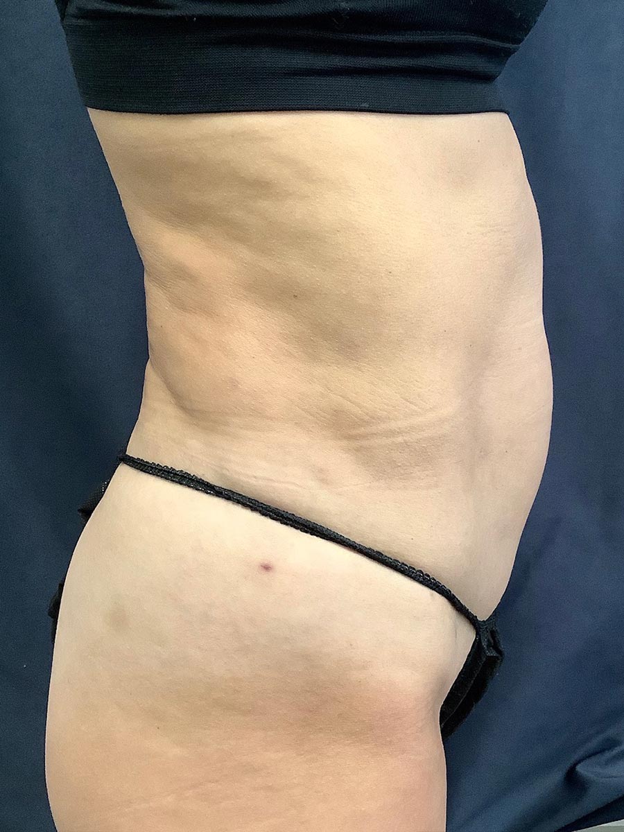Carolina Vein Care & Aesthetics | Greenville, SC | Before After Results: Tumescent Liposuction