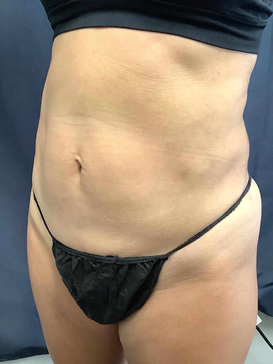 Carolina Vein Care & Aesthetics | Greenville, SC | Before After Results: Tumescent Liposuction