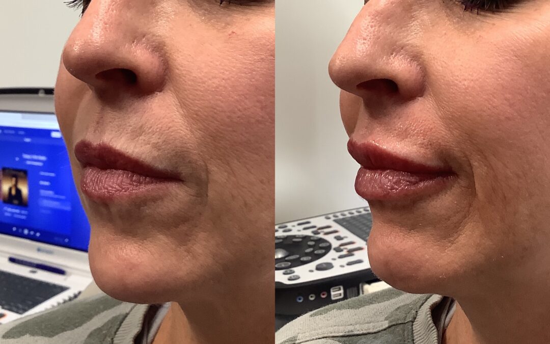 Restylane Fillers: Procedures, Cost, Side Effects, Results, & More