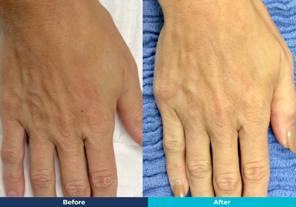 CVC Before & After Images Template - Hand Veins treatment Before & After Carolina Vein Care