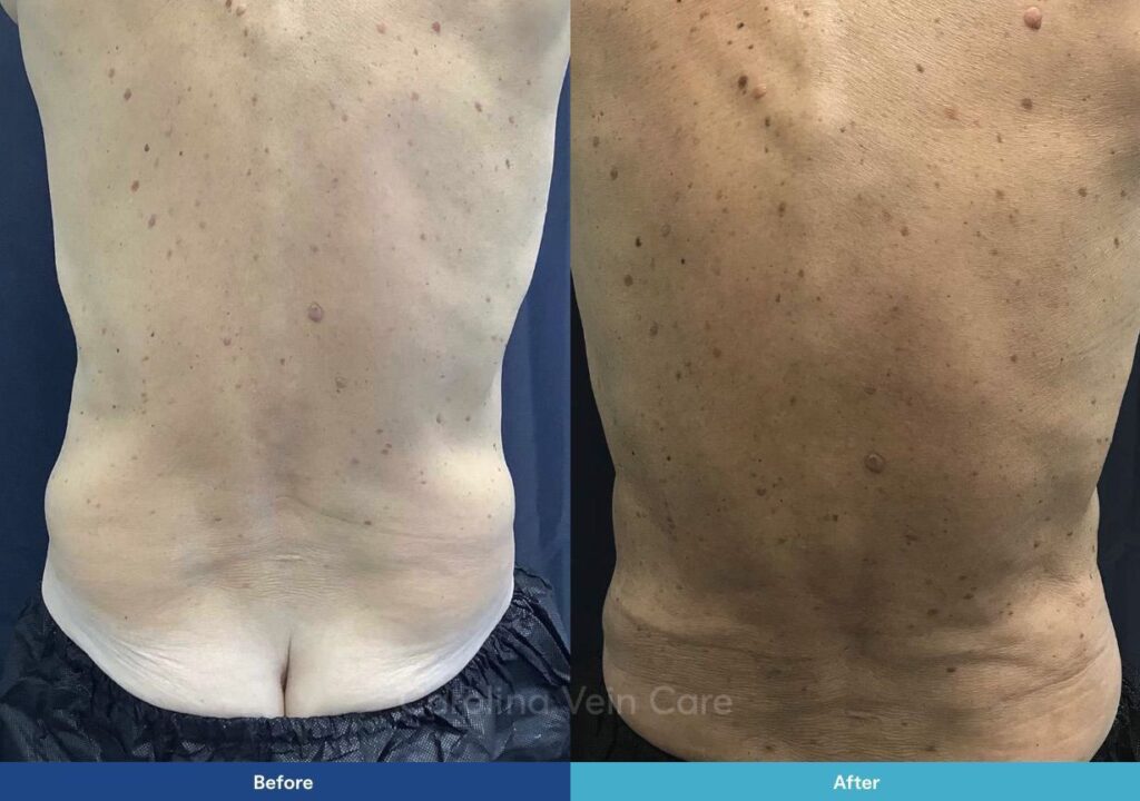 Tumescent Liposuction Before & After Photo Gallery by Dr. Park
