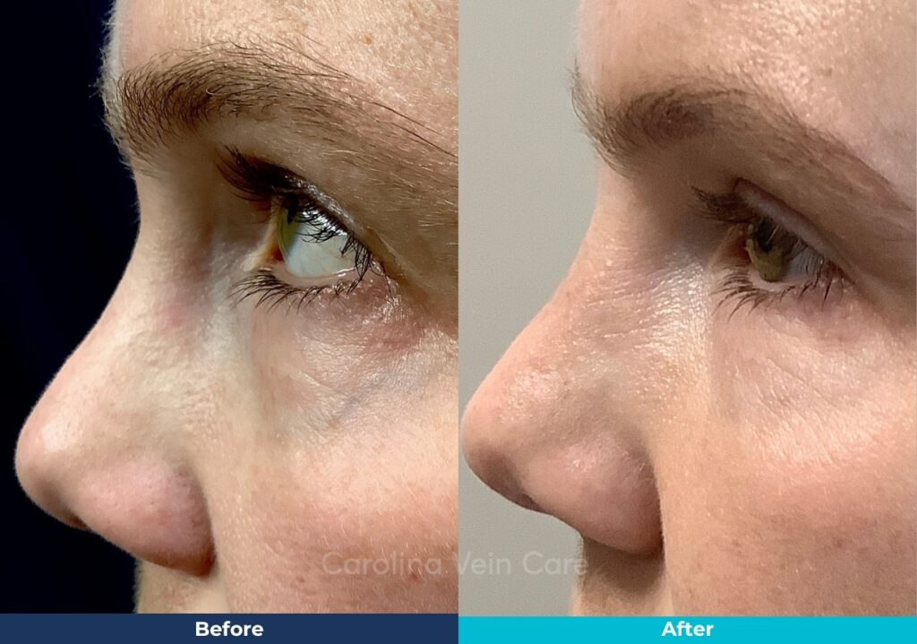 Periorbital eye face vein sclerotherapy treatment Before & After Carolina Vein Care