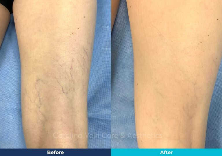 Spider vein legs sclero treatment Before & After Carolina Vein Care 2