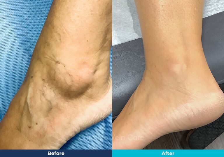 Spider vein sclerotherapy leg treatment before-after-south-carolina-vein-care
