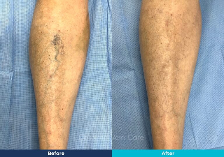 Spider vein sclerotherapy leg treatment before-after-south-carolina-vein-care