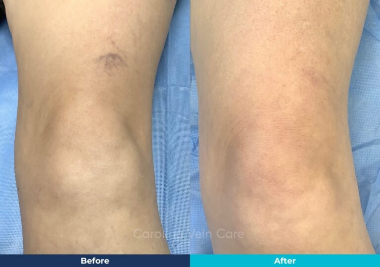 Spider vein sclerotherapy leg treatment before-after-south-carolina-vein-care