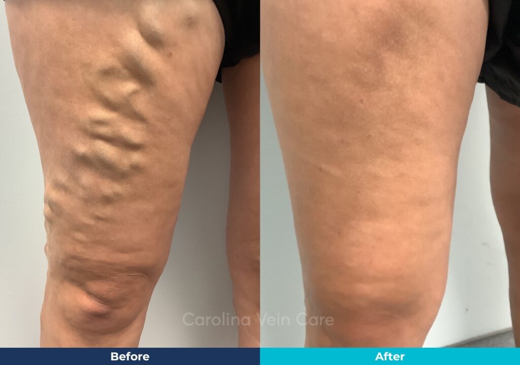 Varicose Vein Leg thigh treatment Before & After Carolina Vein Care
