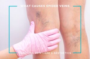 What Causes Spider Veins - Carolina Vein Care