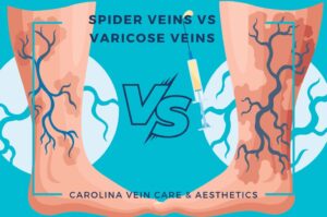 Spider Veins vs Varicose Veins- Carolina Vein Care