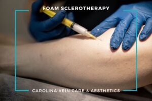 Foam Sclerotherapy - Carolina Vein Care