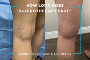 How Long Does Sclerotherapy Last_ at carolina vein care