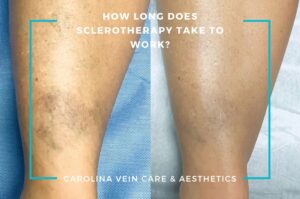 How Long Does Sclerotherapy Take to Work - Carolina Vein Care